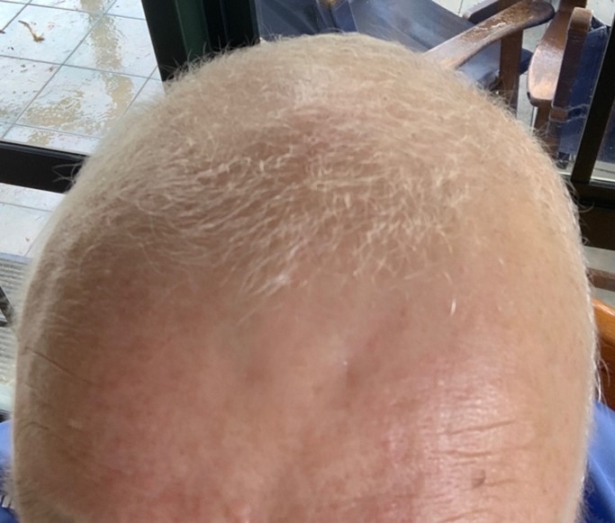 Emerging from a 3-month journey of baldness, March 2022